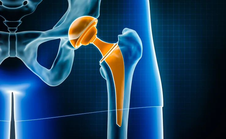 hip-replacement-surgery